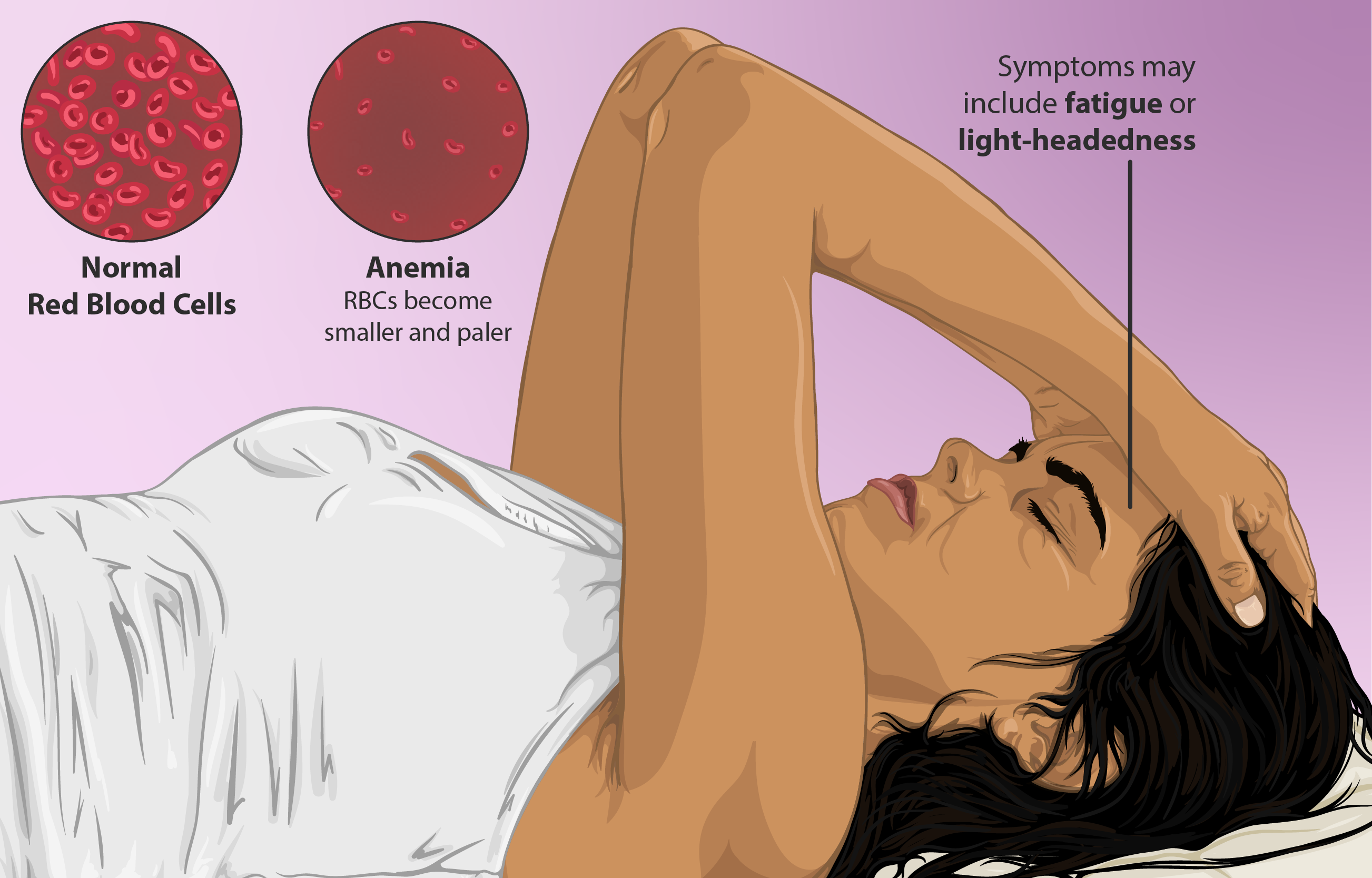 9 Symptoms of Iron Deficiency—and What You Should Eat Instead